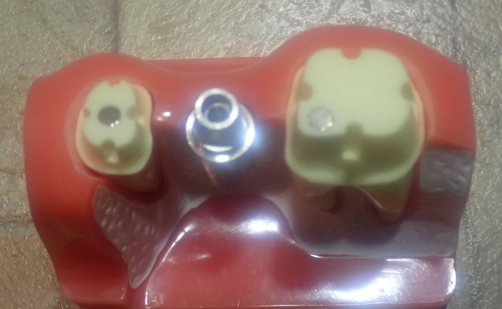 Dental Teeth Model Implant Analysis Study Crown Root Removable Demonstration