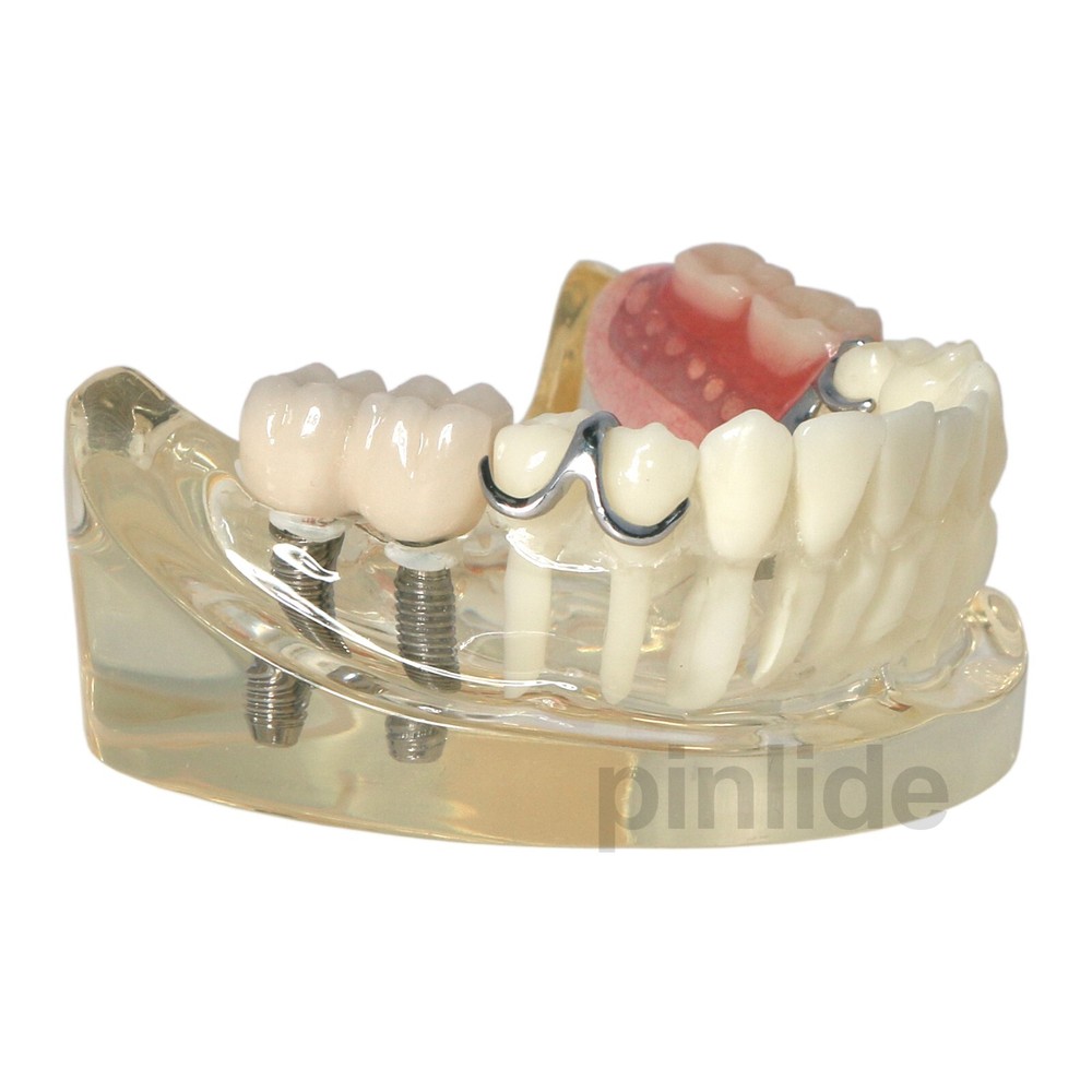 Dental Implant Restoration Typodont Teeth Model with Partial Denture M6022
