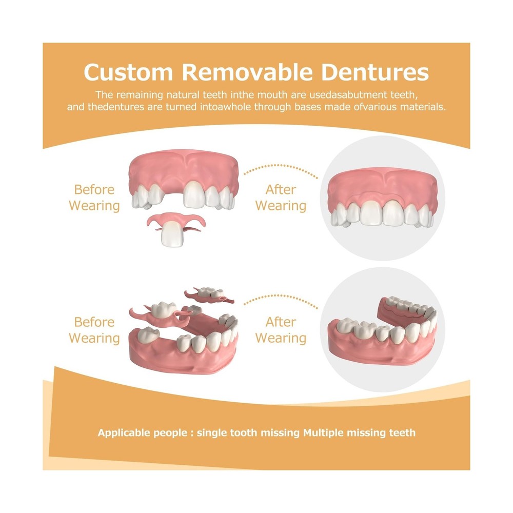 Partial Dentures - Dentures for Missing Teeth & Gaps - Lightweight & Unbreaka...