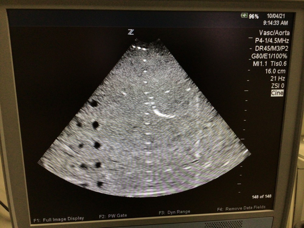 Zonare P4-1 Phased Array Ultrasound Probe -84005