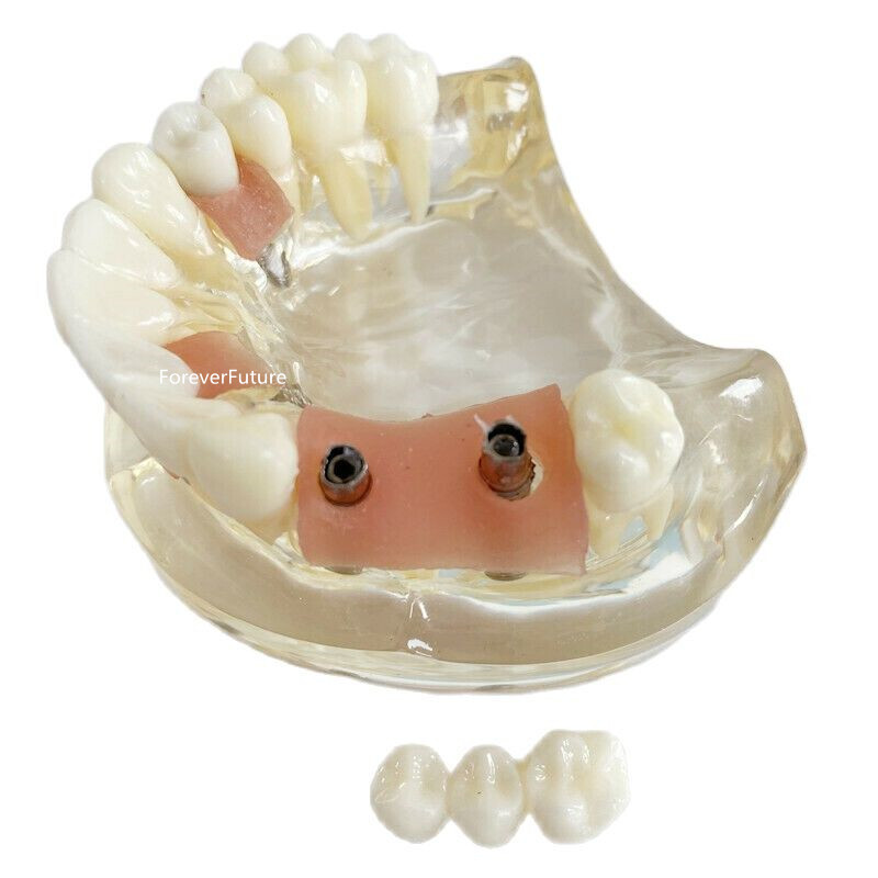 Dental Teeth model with Maryland Bridge Caries Teach Study Model