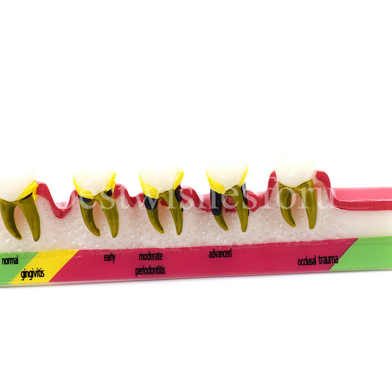 Dental Periodontal Disease Assort Developing Demonstration Teeth Study Model