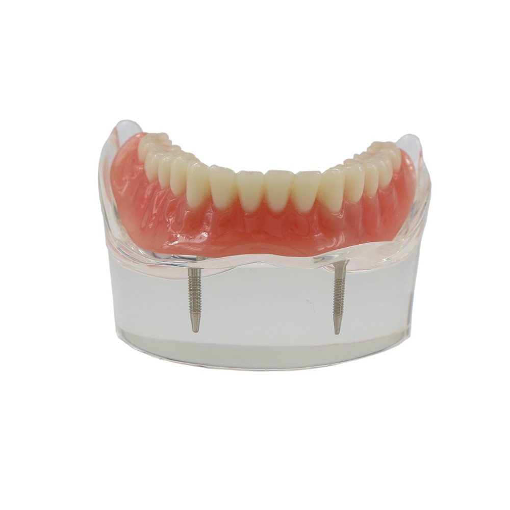 Dental Implant With 2 Implants Teeth Demo Model Overdenture Restoration Model