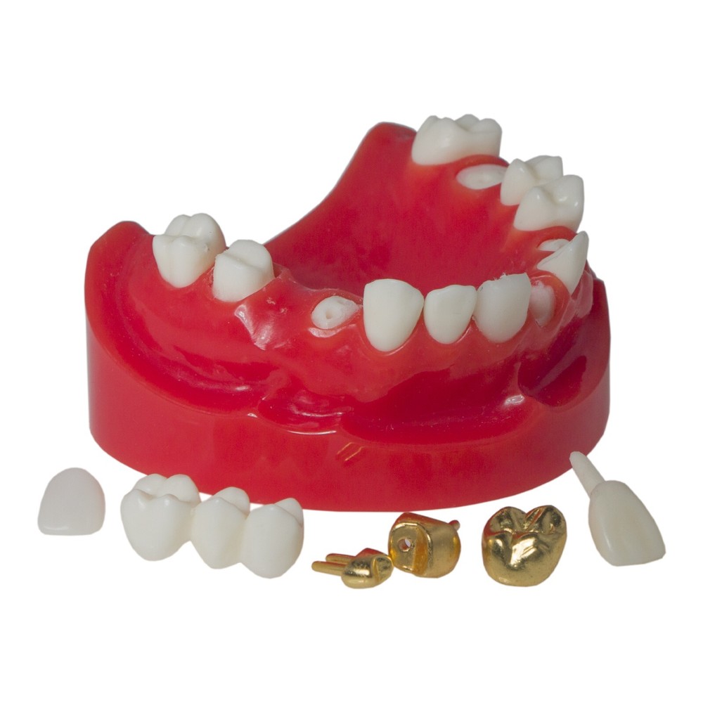 Dental Typodont Teaching Restoration Teeth Model Crown Post Core Bridge M6004