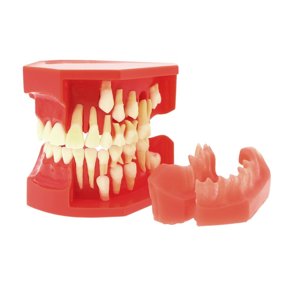 Dental Typodont Teeth Model Pathological Perio Implant Endo Caries Teeth Model