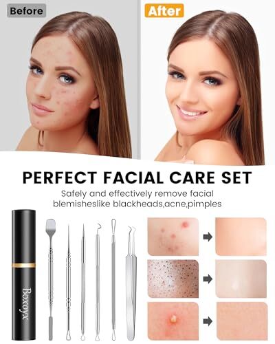 Pimple Popper Tool Kit - 6 Pcs Pore Prep Blackhead Remover Comedone Extractor