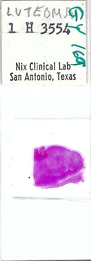 Human Luteoma Pathology Microscope Slide