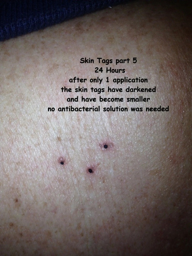 10ml Mole Wart and Skin Tag Remover