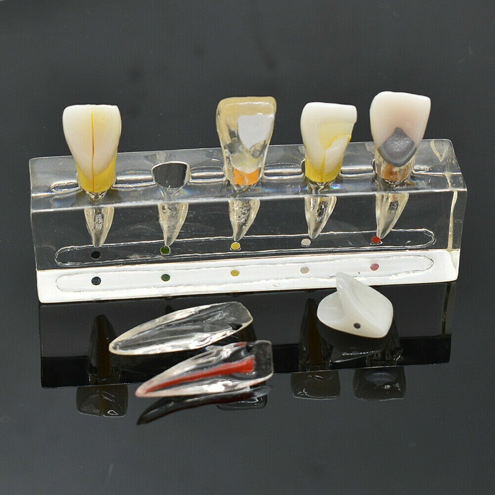 Dental Endodontic Pathology Study Model Demonstration Treatment Anterior Tooth