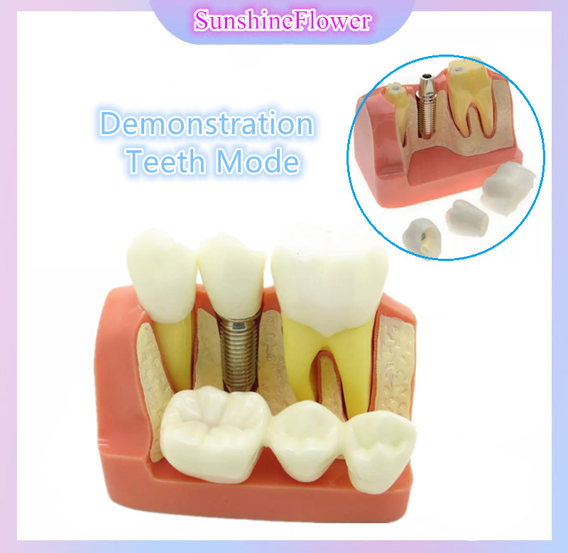 Dental Typodont Implant Analysis Teeth Tooth Model Implant Analysis Crown Bridge