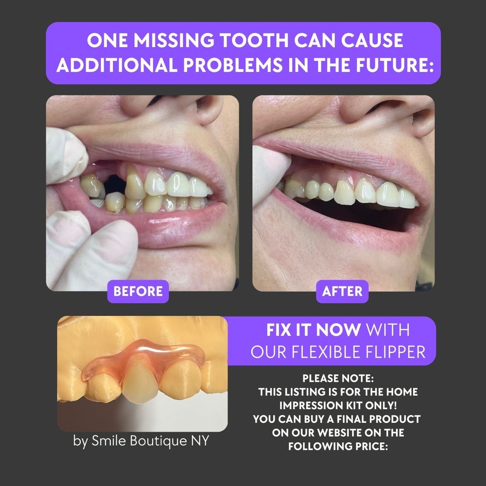 Home Impression Kit for Partial Dentures, Flippers, Removable Veneers, Retainers