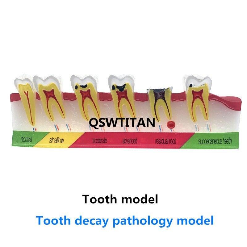 Dental caries classify model of pathological process around Dental caries Model