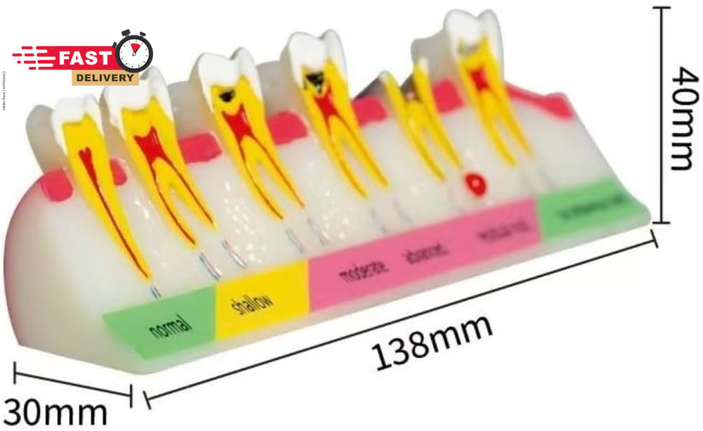 6-Stage Dental Caries Development Model - Anatomical Teeth Decay Demonstration w