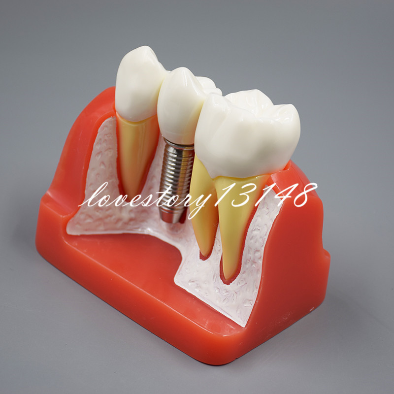 Dental Implant Analysis Crown Bridge Demonstration Teeth Tooth Study Model