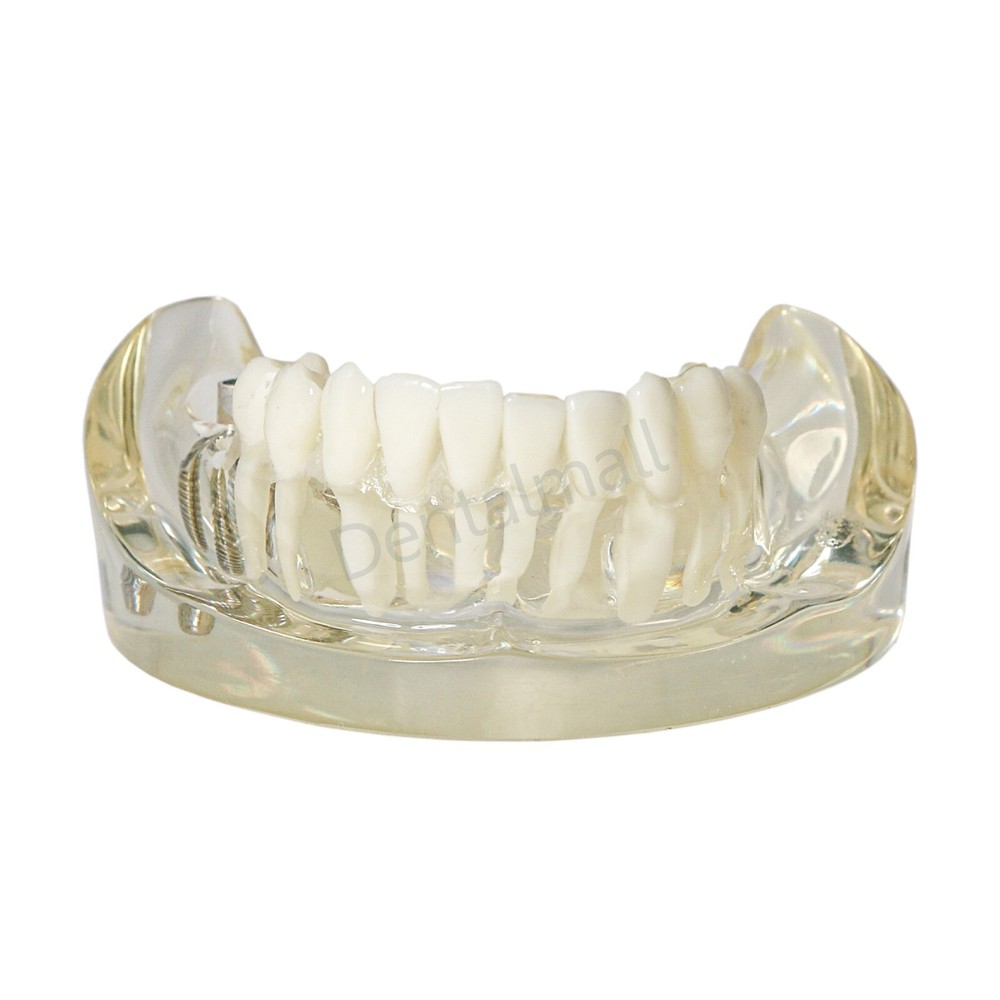 Dental Typodont Restoration Model With 2 Implants Partial Denture Demo