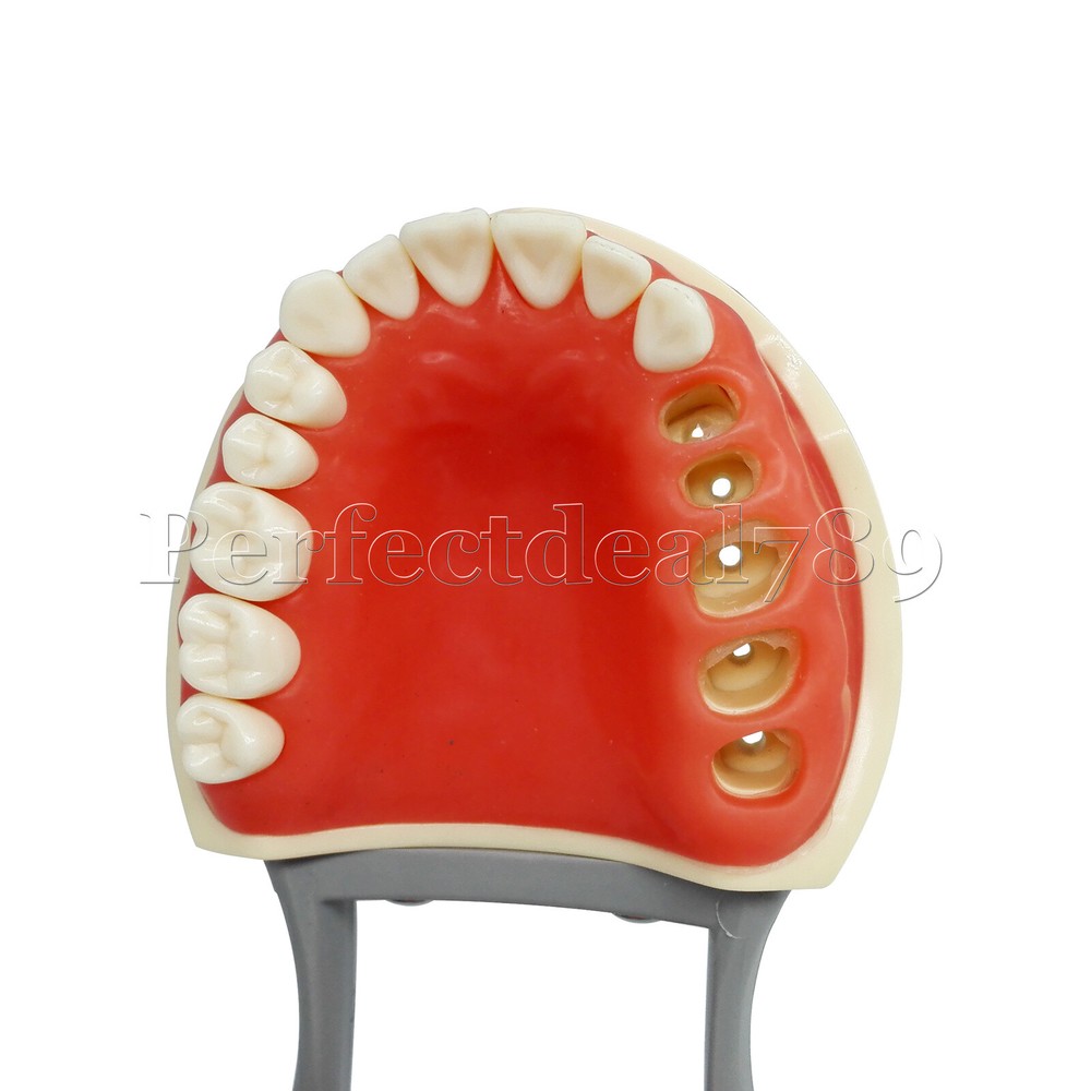 Dental Orthodontics Implant Study Model Analysis Demonstration Tooth Teaching