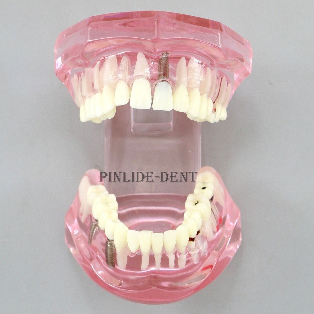 Dental Model Teeth Implant Restoration Bridge Teaching Study Dentist Dentistry