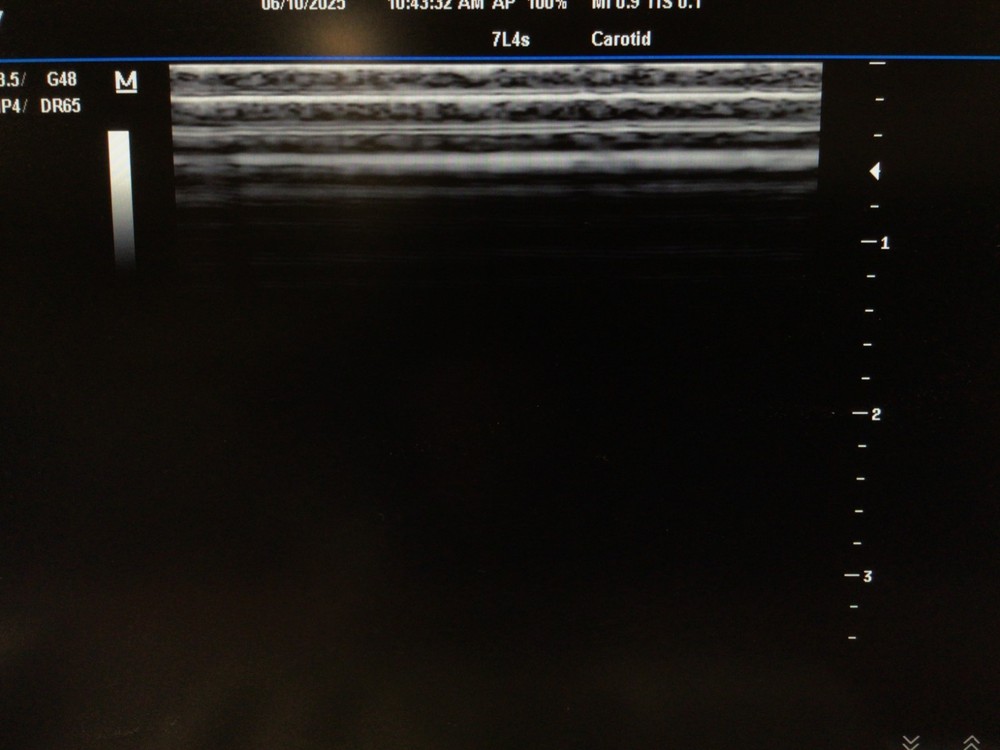 2012 Mindray 7L4s Linear Array Ultrasound Probe
