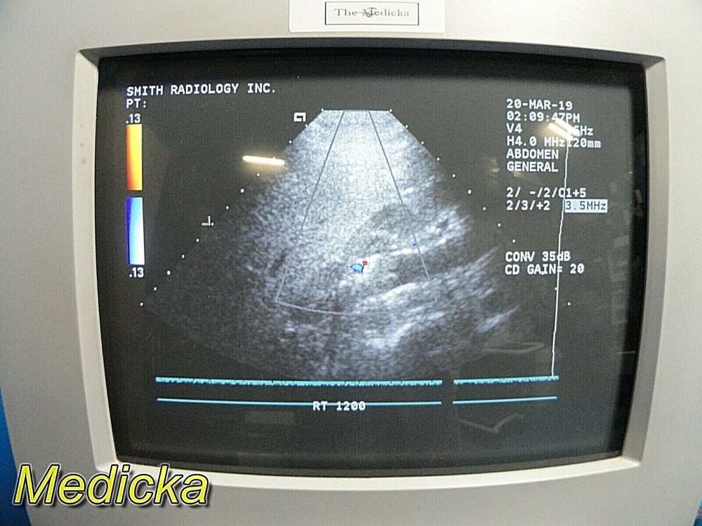 Acuson V4 Vector Array Ultrasound Transducer W/ Pin Connector *TESTED* ~ 17671