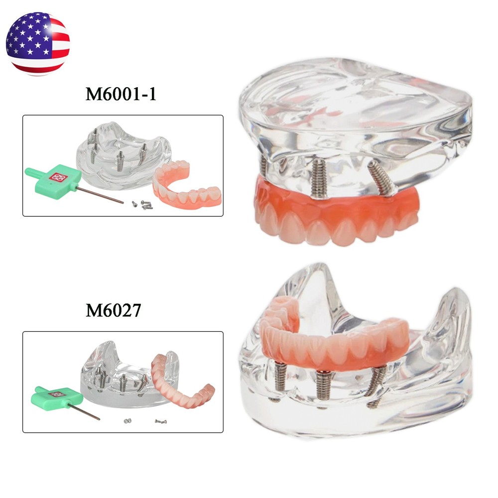 Dental Implant Model All-on-4 Overdenture Treatment Model Upper/Lower 4 Implants