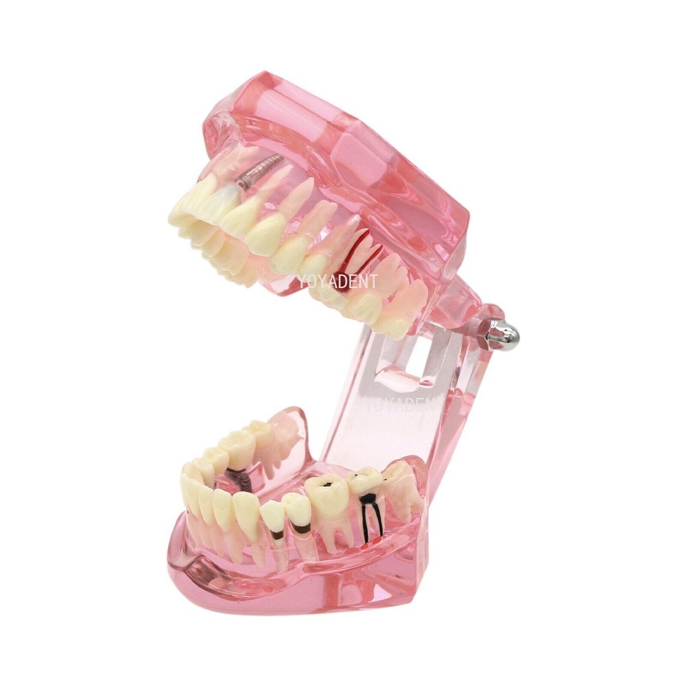 Multiple Types Dental Teaching Teeth Model Typodont Ortho Implant Practice Demo