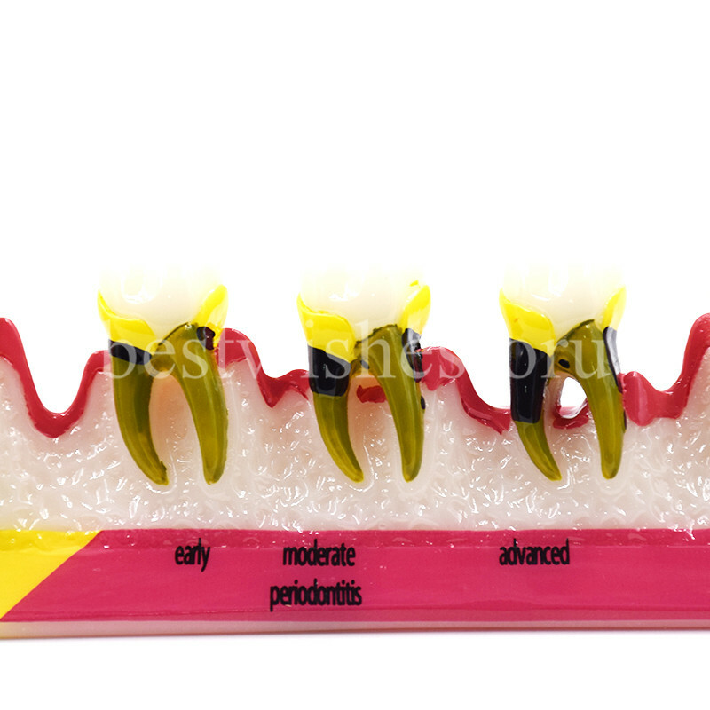 Dental Periodontal Disease Assort Developing Demonstration Teeth Study Model