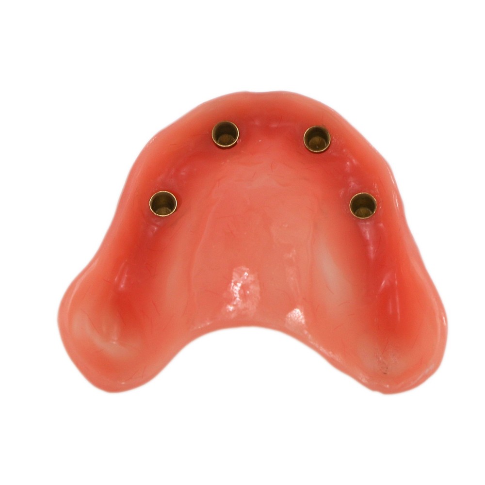 Dental Teeth Model Overdenture Removable Teeth Upper/Lower Jaw 4 Implants Model