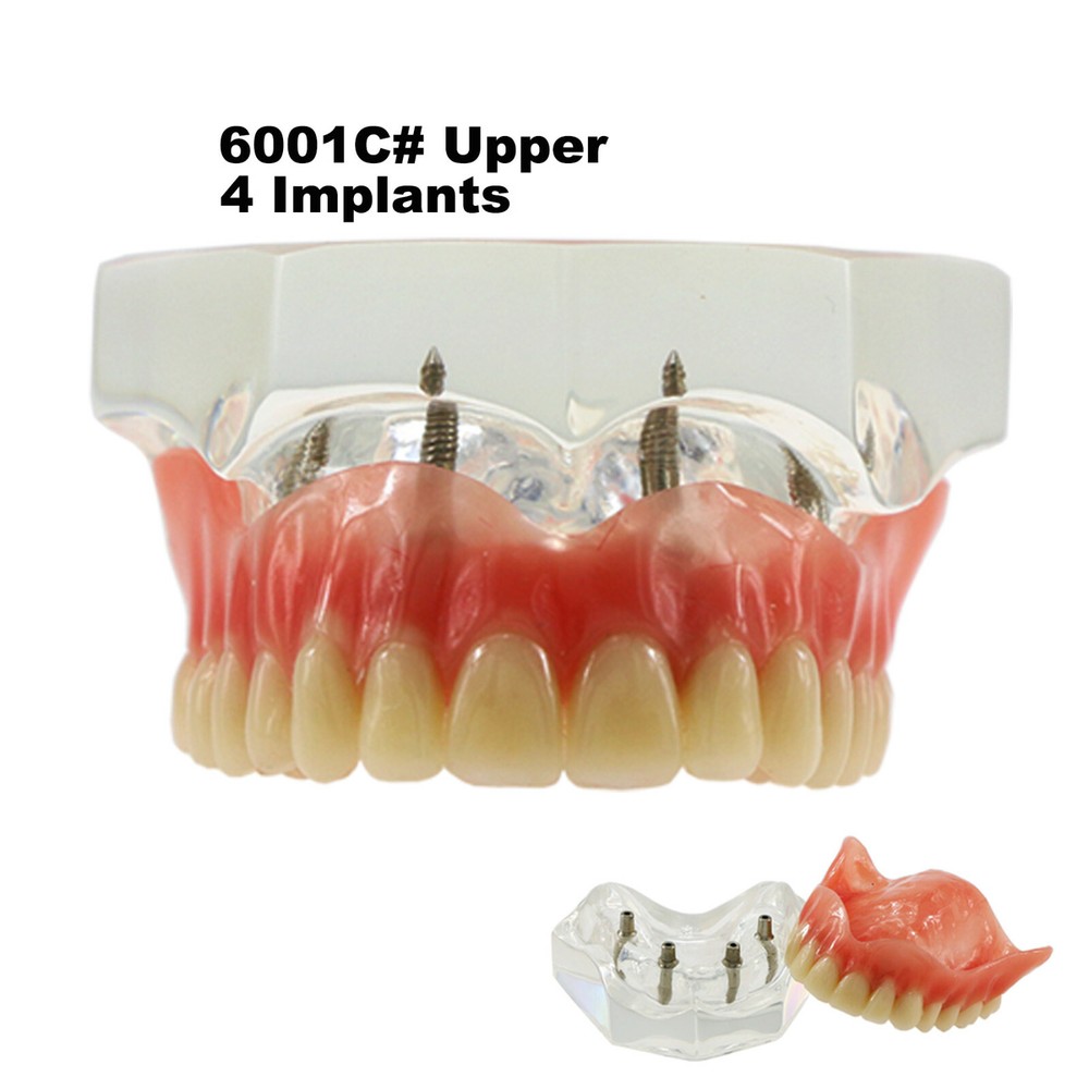 Dental Typodont Teeth Model 4 Implants Upper Overdenture Superior M6001 Clear
