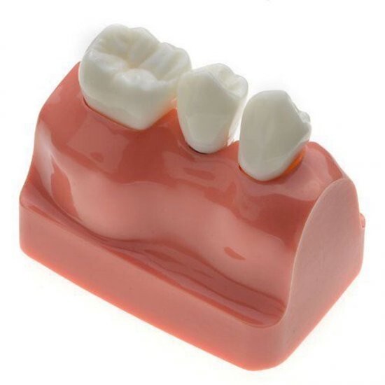 Dental Demonstration Teeth Tooth Model Typodont Implant Analysis Crown Bridge