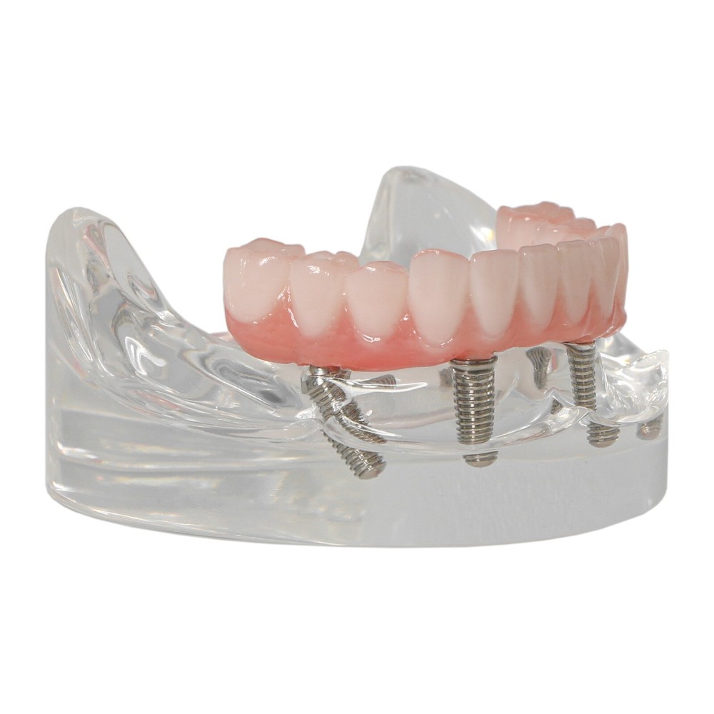 Upper/Lower Dental Typodont Implant Model with Detachable Post Core Bridge&Screw