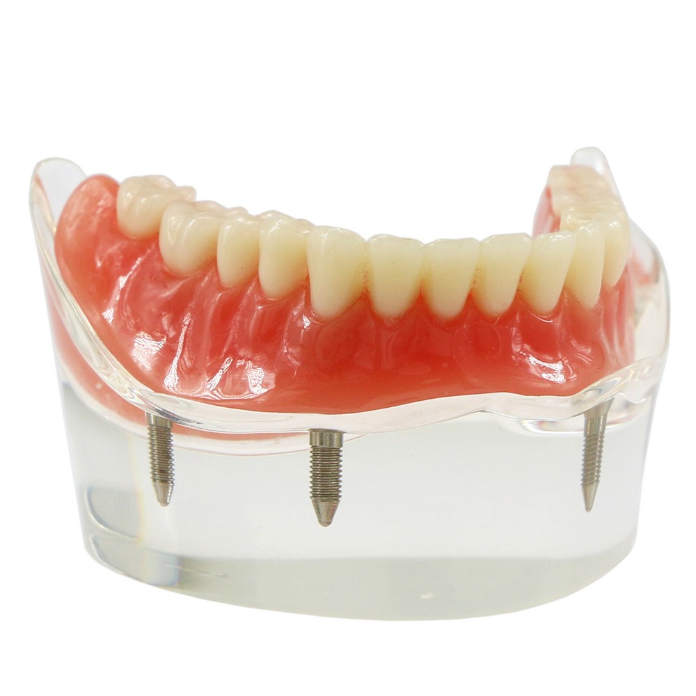 Dental Typodont Teeth Model Overdenture Lower Inferior 4 Implants Demo M6003