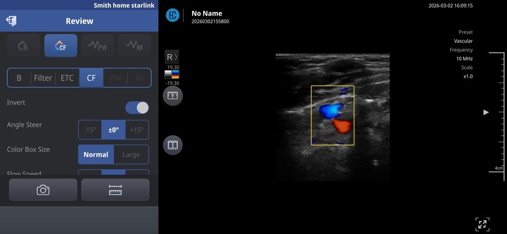 SONON 300L Linear Array Wireless Ultrasound Probe Device