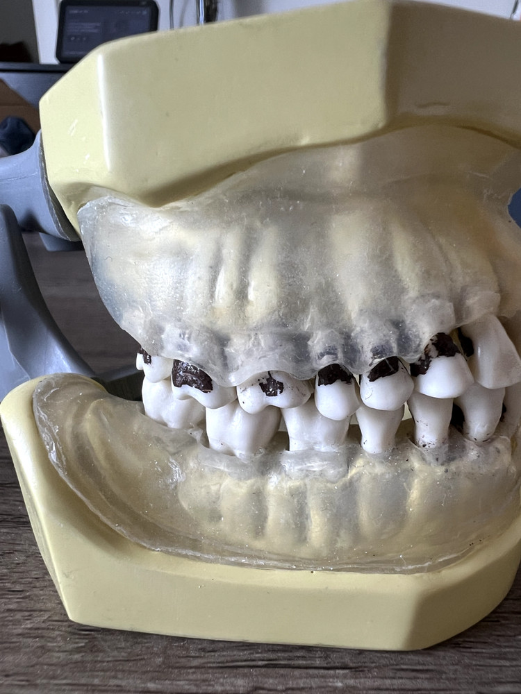 Nissin Periodontal Typodont Includes Both Upper And Lower Arch