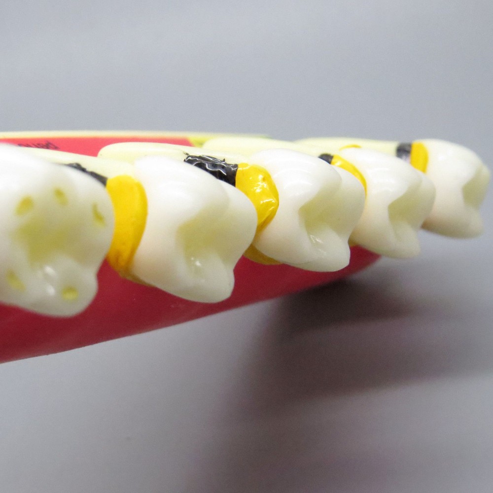 1 Pcs Dental Dentoform Typodont Study Teaching Model Periodontal Disease Assort