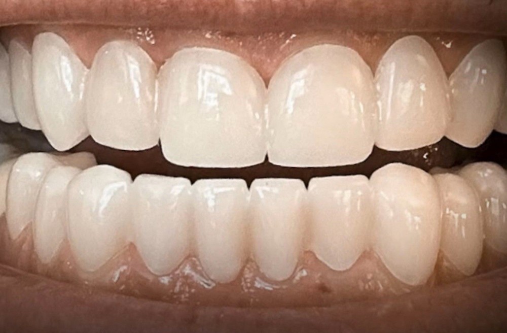 Custom Upper or Lower Cosmetic Click on Veneer