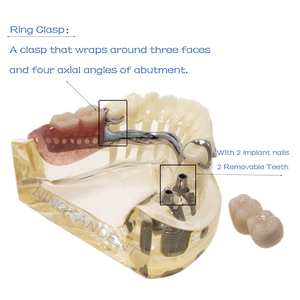 Dental Implant RPD Restoration Model Removable Partial Denture Lower 2 Implants