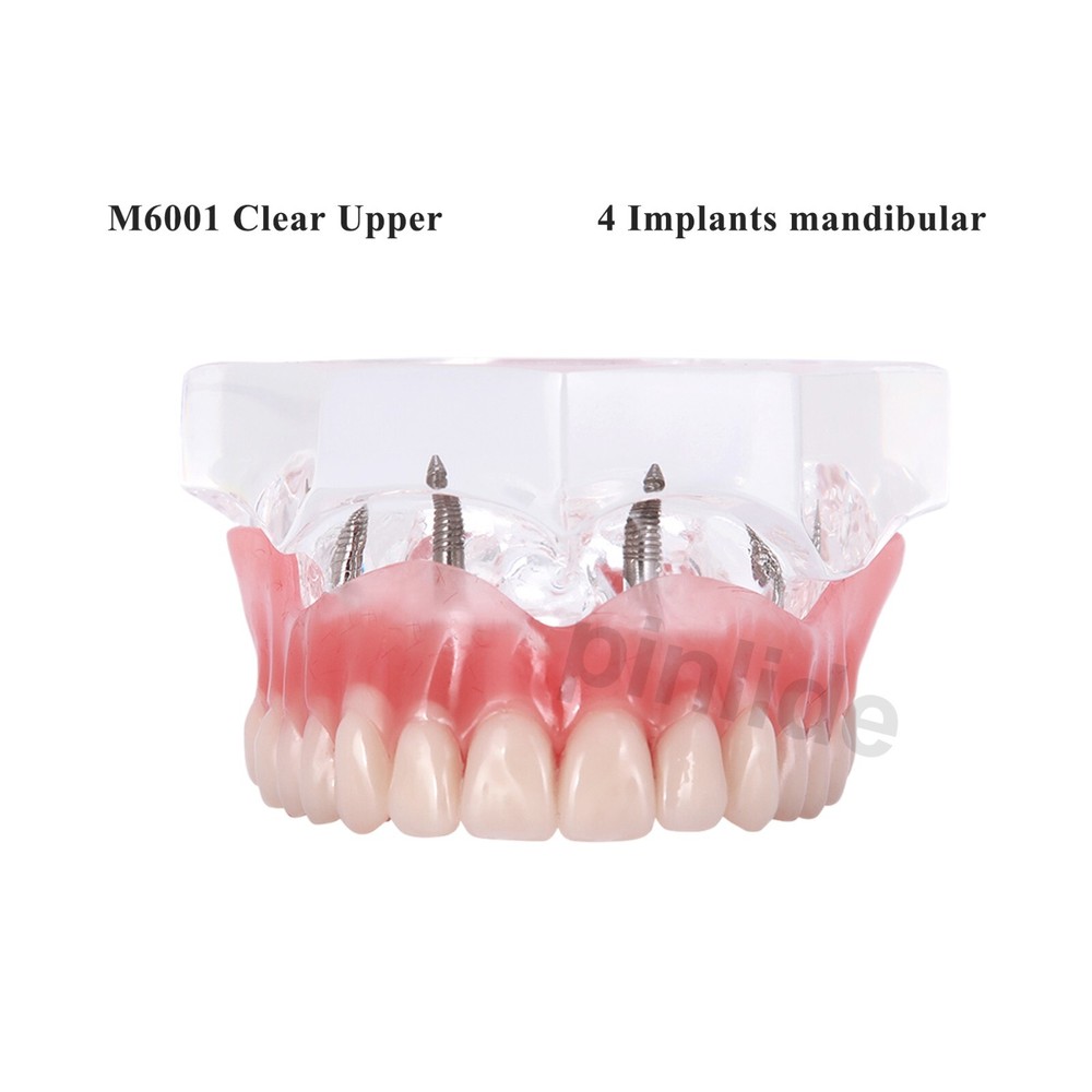 Dental Implant Demo Restoration 4 Implants Upper Overdenture Teeth Model M6001C