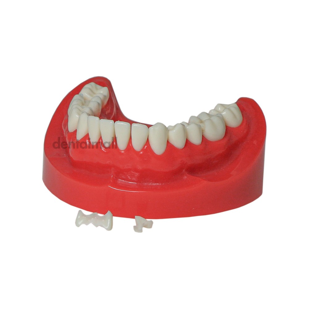 Dental Teeth Crown Restoration Model with Post Core Bridge for Teaching M6004