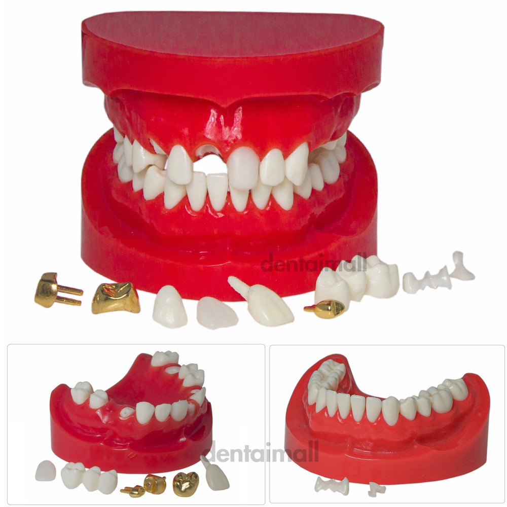 Dental Teeth Crown Restoration Model with Post Core Bridge for Teaching M6004