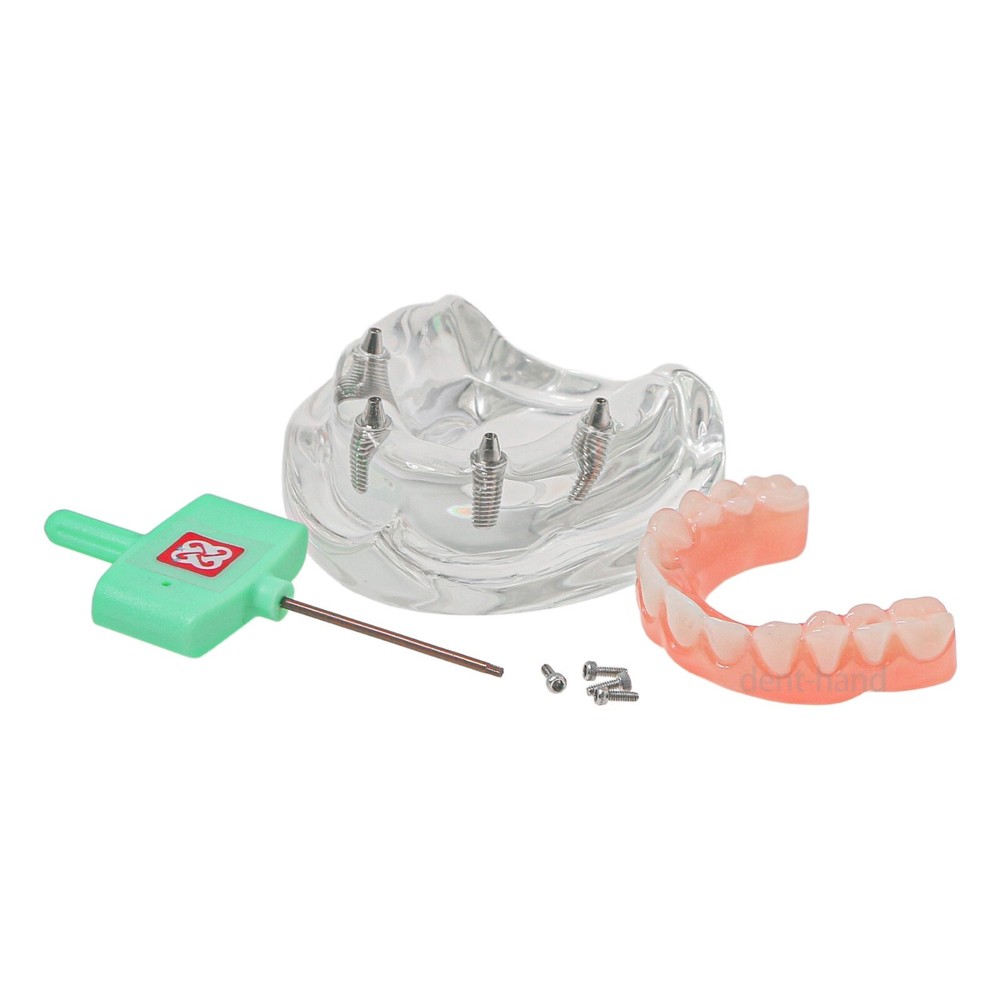 US Dental Overdenture Upper/Lower 4 Implants Demo Teeth Restoration Model