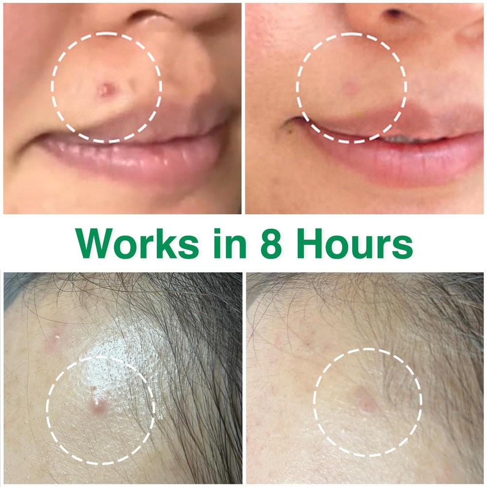 Acropass Acne Cure DEN Microarray Patch 4 Pack | Microneedle Acne Treatment