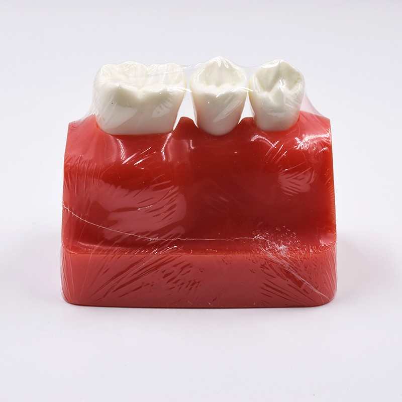 Dental Implant Analysis Crown Bridge Demonstration Teeth Study Model Typodont