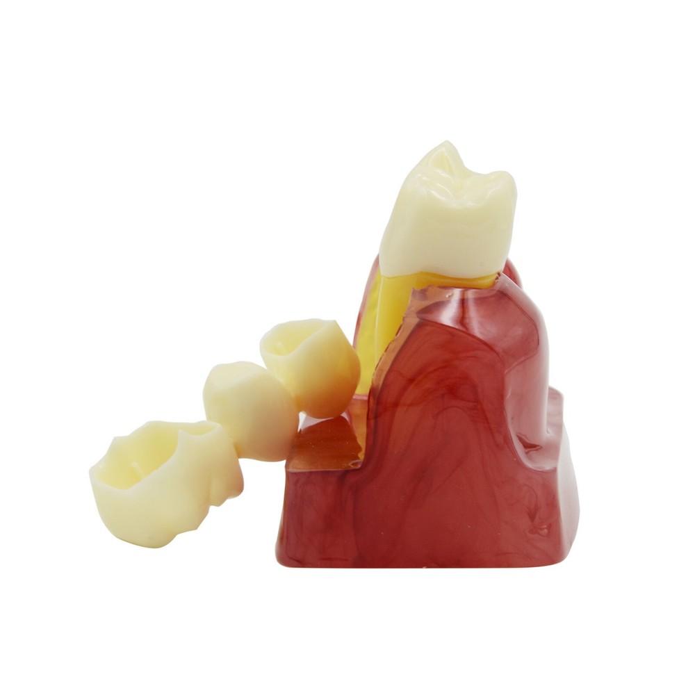 Dental Demonstration Teeth Tooth Model Typodont Implant Analysis Crown Bridge