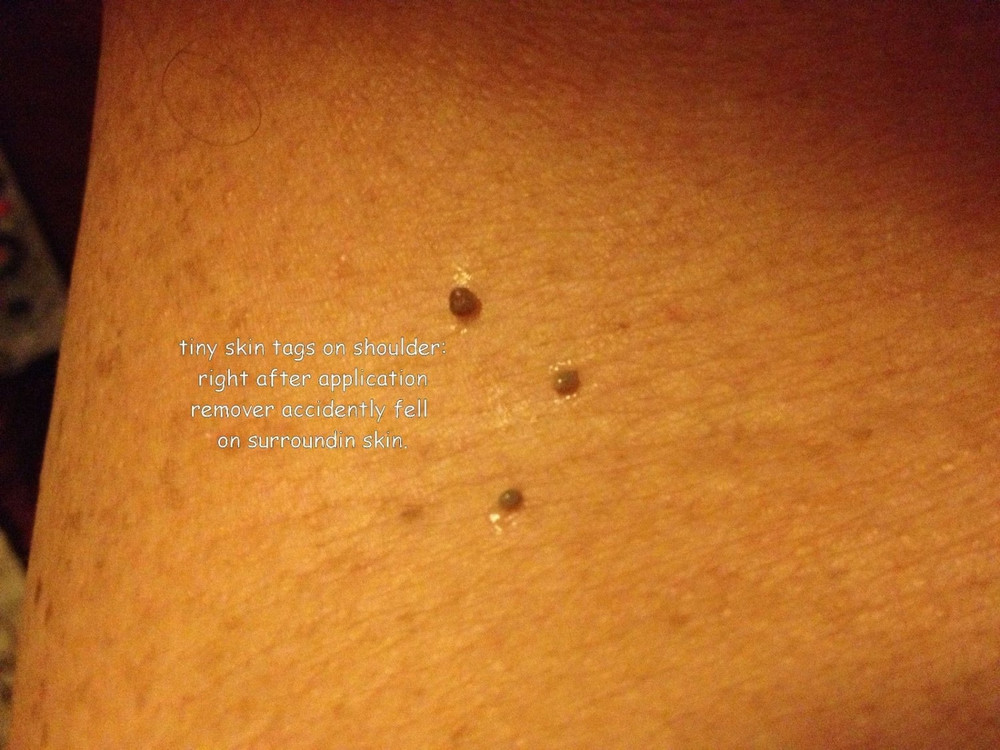 10ml Mole Wart and Skin Tag Remover