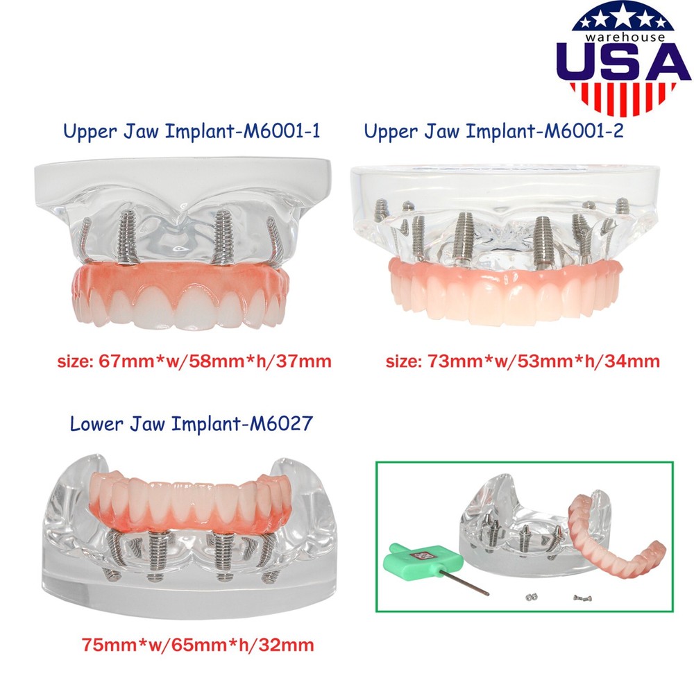 Upper/Lower Dental Typodont Implant Model with Detachable Post Core Bridge&Screw