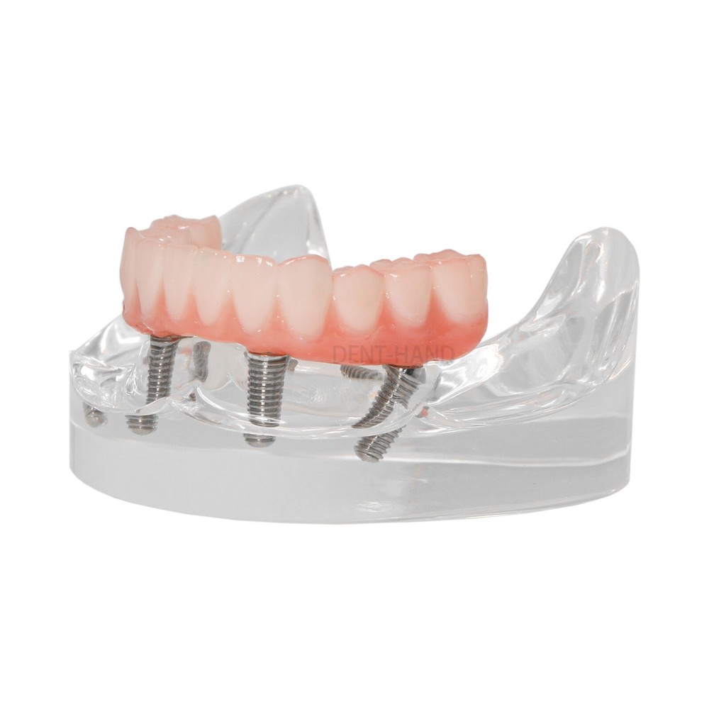 Dental Overdenture Upper/Lower Jaw Implant Model 4 Screws with Post Core Bridge