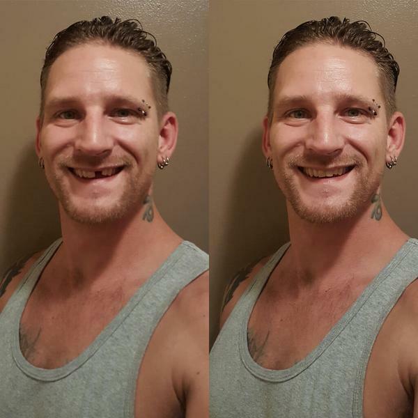 Temptooth Kit Original Temp tooth Missing Tooth Replacement Over 250,000 Sold