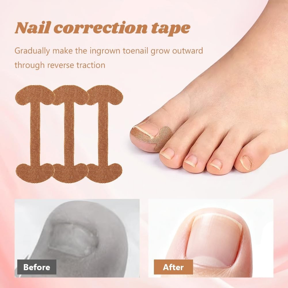 16 Pcs Ingrown Toenail Corrector Set with Correction Strips,Curved silver