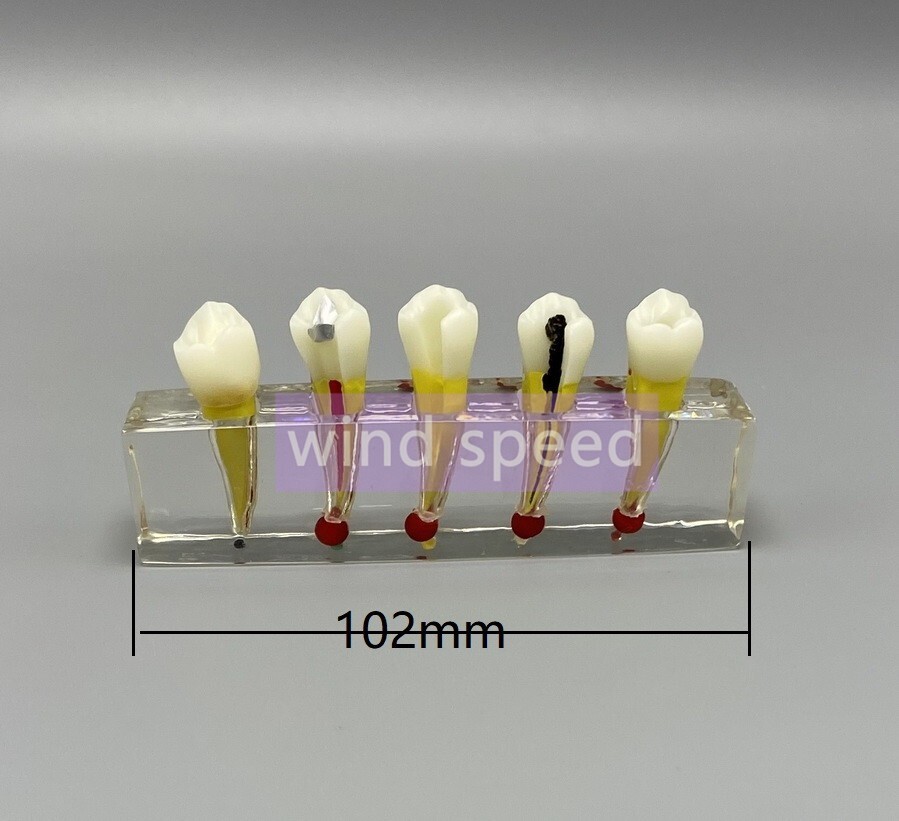 Dental Study Model Pulp Disease root canal curing Clinical Demonstration Analysi
