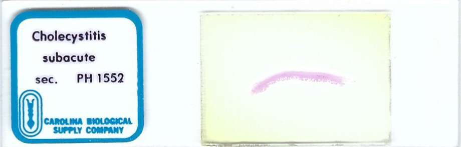 Human Cholecystitis Subacute Pathology Microscope Slide